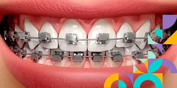 Как долго болят зубы после установки брекетов?