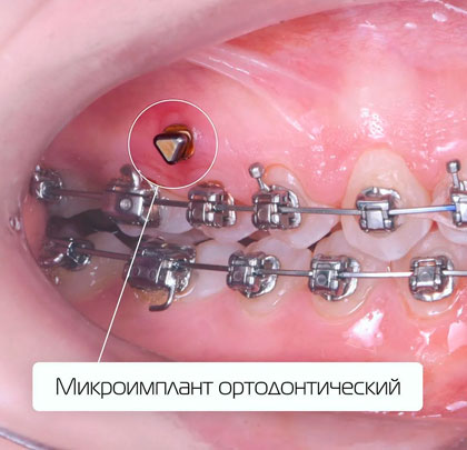Ортодонтические импланты