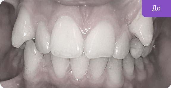  Ортодонтическое лечение брекет-системой Damon Q